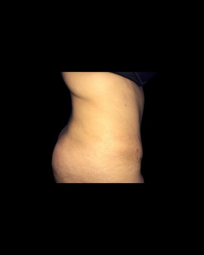 Tummy Tuck Before & After Patient #21271