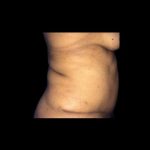 Tummy Tuck Before & After Patient #21279