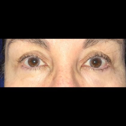Blepharoplasty Before & After Patient #20880