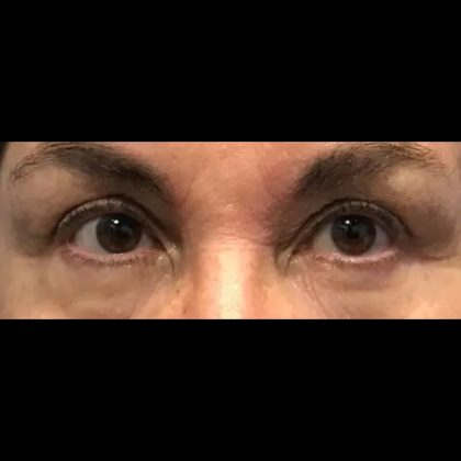 Blepharoplasty Before & After Patient #20880