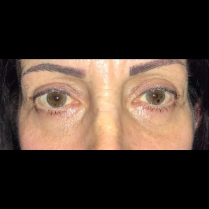 Blepharoplasty Before & After Patient #20882