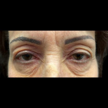 Blepharoplasty Before & After Patient #20882