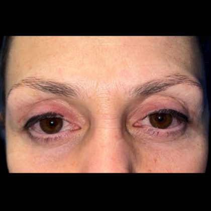 Blepharoplasty Before & After Patient #20887