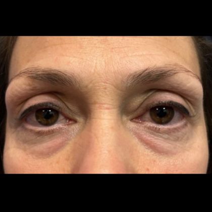 Blepharoplasty Before & After Patient #20887