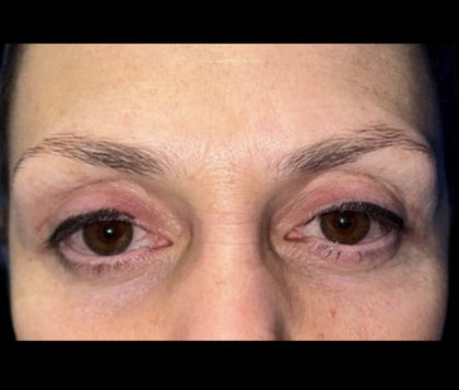 Blepharoplasty Before & After Patient #20141