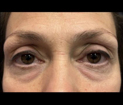 Blepharoplasty Before & After Patient #20141