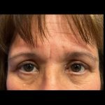 Blepharoplasty Before & After Patient #20162