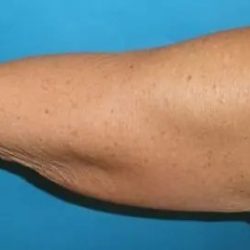 Arm Lift Before & After Patient #20912