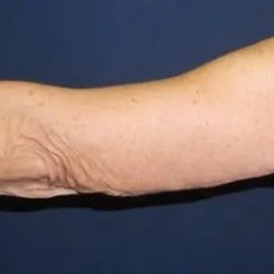 Arm Lift Before & After Patient #20912