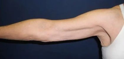 Arm Lift Before & After Patient #20912