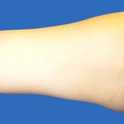 Arm Lift Before & After Patient #20924