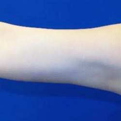 Arm Lift Before & After Patient #20924