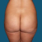Brazilian Butt Lift Before & After Patient #20943