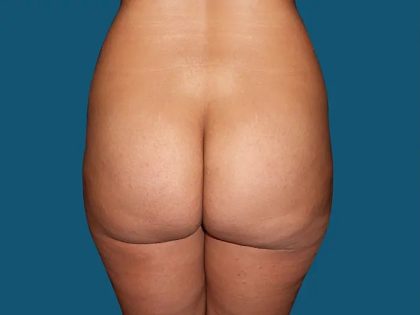 Brazilian Butt Lift Before & After Patient #20943