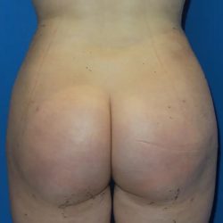 Brazilian Butt Lift Before & After Patient #20955