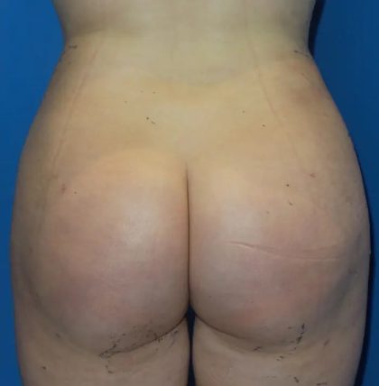 Brazilian Butt Lift Before & After Patient #20955