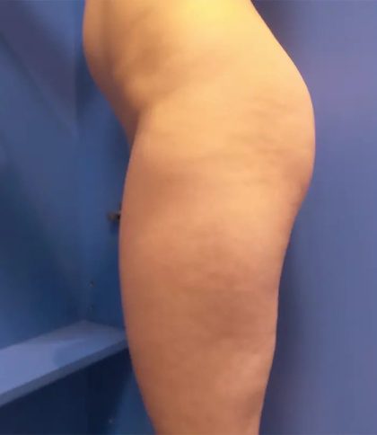Brazilian Butt Lift Before & After Patient #20955