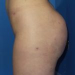 Brazilian Butt Lift Before & After Patient #20955
