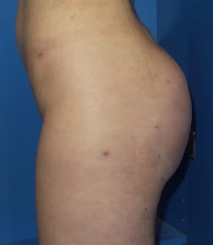 Brazilian Butt Lift Before & After Patient #20955