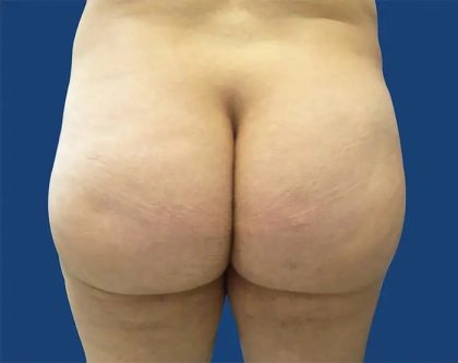 Brazilian Butt Lift Before & After Patient #20966