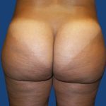 Brazilian Butt Lift Before & After Patient #20966
