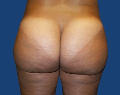 Brazilian Butt Lift Before & After Patient #20966