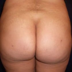 Brazilian Butt Lift Before & After Patient #20967