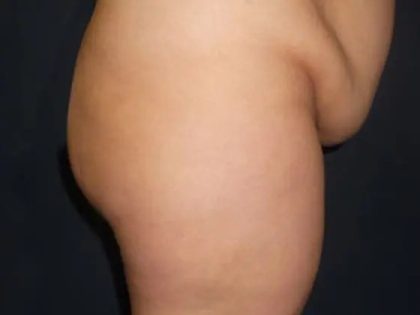 Brazilian Butt Lift Before & After Patient #20967
