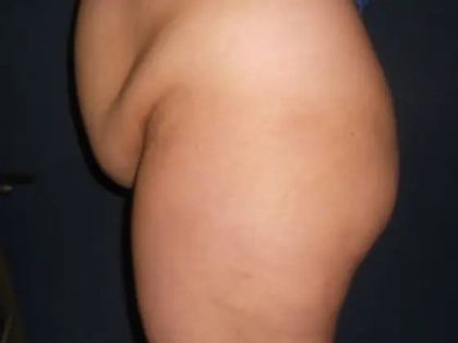 Brazilian Butt Lift Before & After Patient #20967
