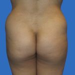 Brazilian Butt Lift Before & After Patient #21022