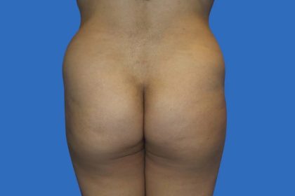 Brazilian Butt Lift Before & After Patient #21022