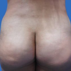 Brazilian Butt Lift Before & After Patient #21022