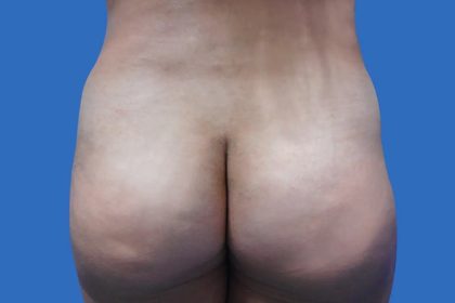 Brazilian Butt Lift Before & After Patient #21022