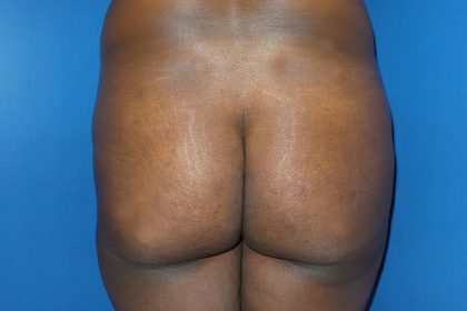 Brazilian Butt Lift Before & After Patient #21024