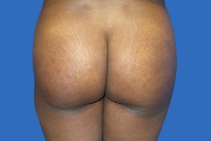 Brazilian Butt Lift Before & After Patient #21024