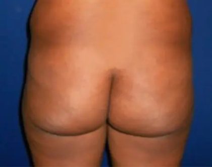 Brazilian Butt Lift Before & After Patient #21025