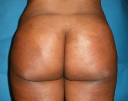 Brazilian Butt Lift Before & After Patient #21025