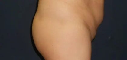 Brazilian Butt Lift Before & After Patient #21026