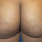 Brazilian Butt Lift Before & After Patient #21027