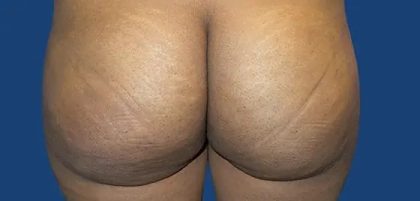 Brazilian Butt Lift Before & After Patient #21027