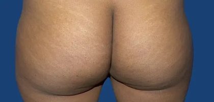 Brazilian Butt Lift Before & After Patient #21027