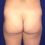 Brazilian Butt Lift Before & After Patient #21032