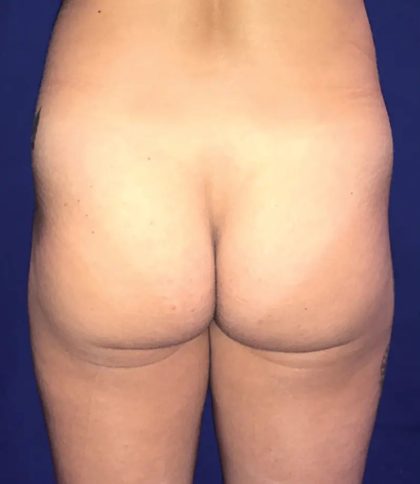 Brazilian Butt Lift Before & After Patient #21032