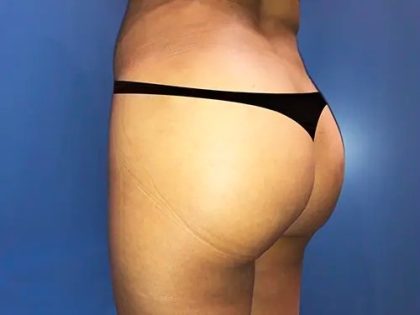 Brazilian Butt Lift Before & After Patient #21033