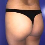 Brazilian Butt Lift Before & After Patient #21033