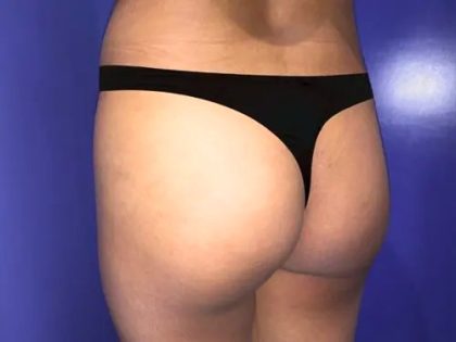 Brazilian Butt Lift Before & After Patient #21033