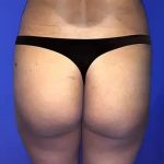 Brazilian Butt Lift Before & After Patient #21034