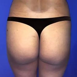 Brazilian Butt Lift Before & After Patient #21034