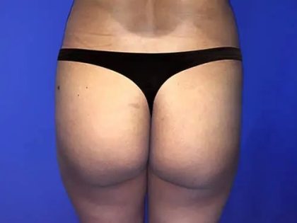 Brazilian Butt Lift Before & After Patient #21034