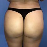 Brazilian Butt Lift Before & After Patient #21034